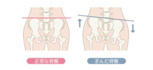 産後の骨盤の歪み